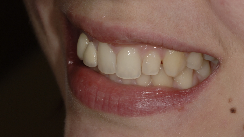 agenesia odontoiatrico diastema faccette