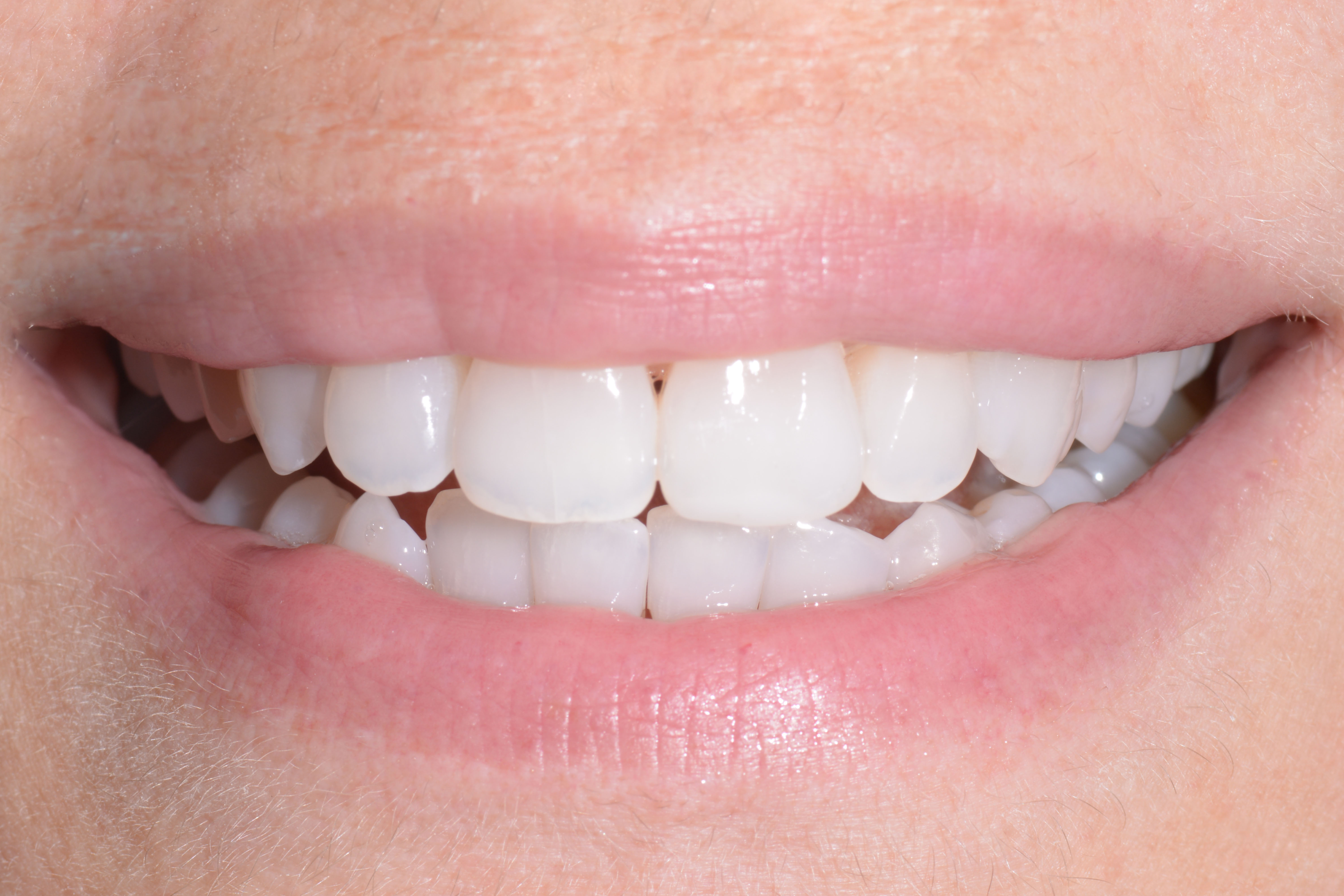 Ritrova il tuo sorriso! Ecco come e quando è possibile curare un dente cariato o fratturato!