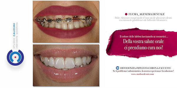 ortodonzia, protesi, corona, faccetta, denti, calesini, studio calesini, gaetano calesini, roma, centro, rome, center, dentist, dentista, odontoiatra, odontoiatria, dentistry, dentist, tooth, smile, beauty, best dentist in rome center, protesi, faccette, corone, corona, faccetta, impianti, impianto, dental, dentale