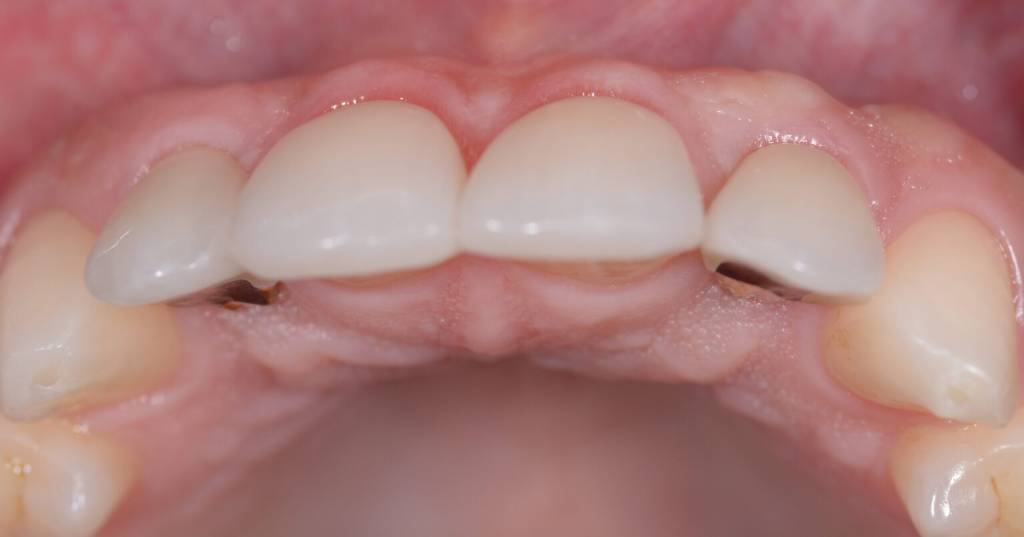 Agenesia Dentale, agenesie dentali, protesi, corone, faccette, apparecchio, dentista, odontoiatria estetica, ortodonzia, ponte, maryland,