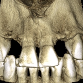 Agenesia Dentale, agenesie dentali, protesi, corone, faccette, apparecchio, dentista, odontoiatria estetica, ortodonzia, ponte, maryland,