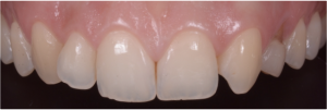 Denti Incisivi, protesi, corone, faccette, apparecchio, dentista, odontoiatria estetica, ortodonzia, ponte, maryland,