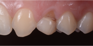 Denti incisivi, Agenesia Dentale, agenesie dentali, protesi, corone, faccette, apparecchio, dentista, odontoiatria , ortodonzia, ponte, maryland,