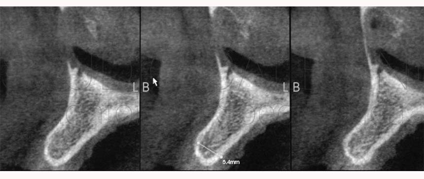 Mancanza dei denti Agenesie dentali, impianti dentali, ortodonzia, odontoiatria estetica, dentista roma, dentista,