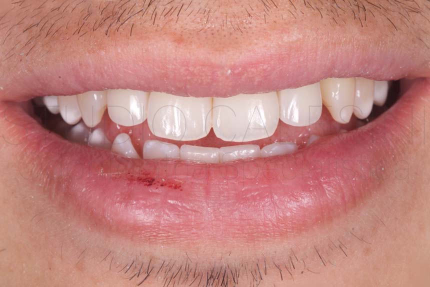 Mancanza dei denti Agenesie dentali, impianti dentali, ortodonzia, odontoiatria estetica, dentista roma, dentista,