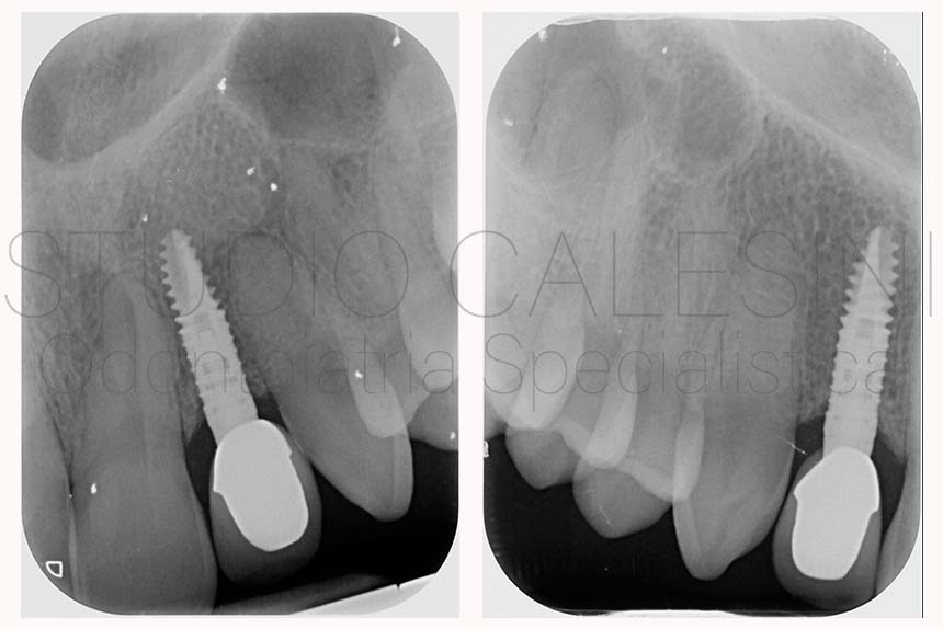 Agenesie dentali, impianti dentali, ortodonzia, odontoiatria estetica, dentista roma, dentista, agenesie dentali, agenesia dentale, agenesie, agenesia, sorriso gengivale, sorriso, gengivale, gengive, gengiva, dentale, denti, impianto, impianto dentale, impianti dentali, impianto mal posto, smile gum, gum, smile, dentista roma, gaetano calesini, calesini, scuzzo, coppe, centro, dentista roma, dentista, denti, edentulo,