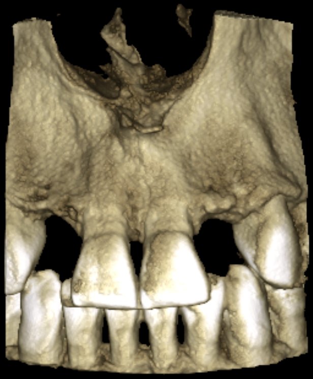 Ricostruzione 3D CBCT in un sito di agenesia, Studio Calesini Roma