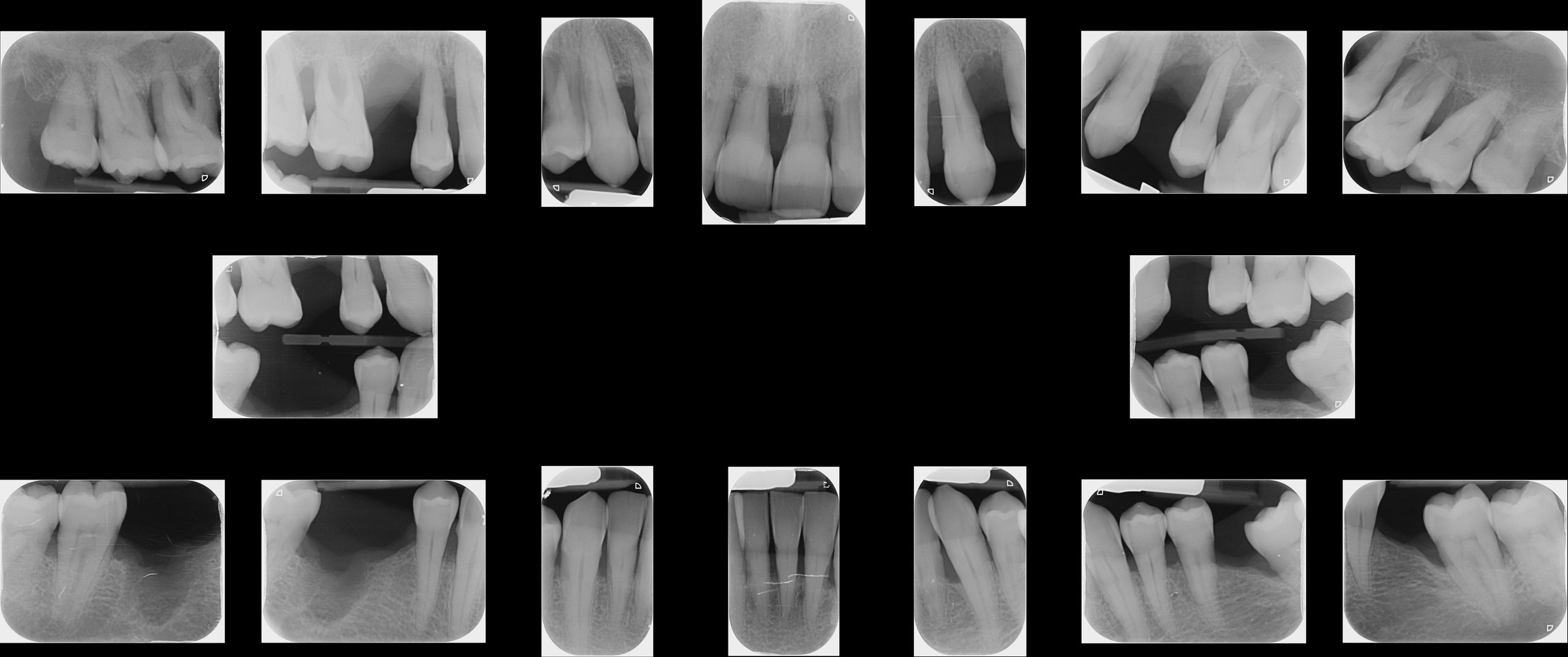 Status radiografico completo, diagnosi parodontale, Studio Calesini Roma