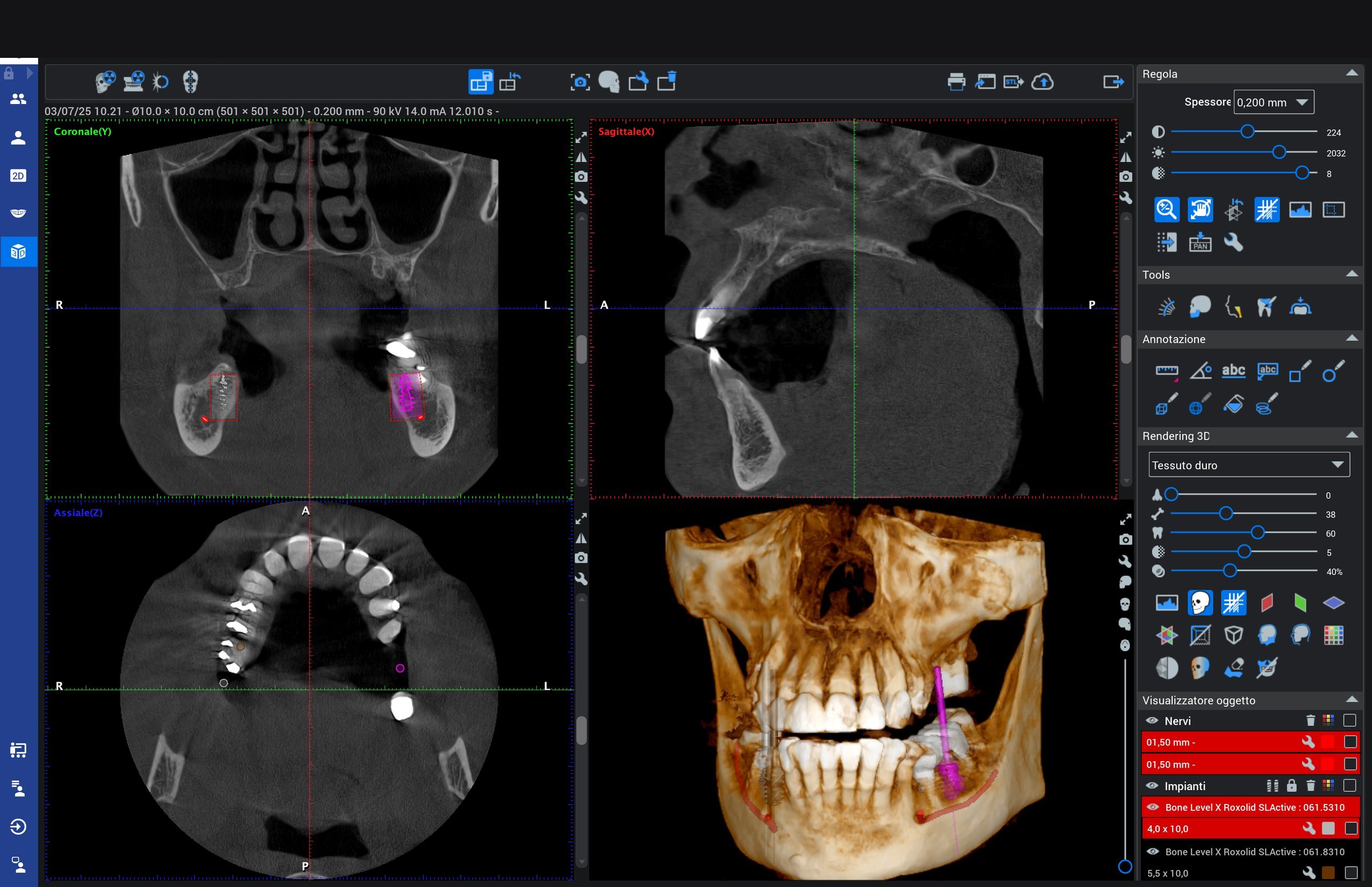 Identificazione cause, CBCT pianificazione implantologica, Studio Calesini Roma