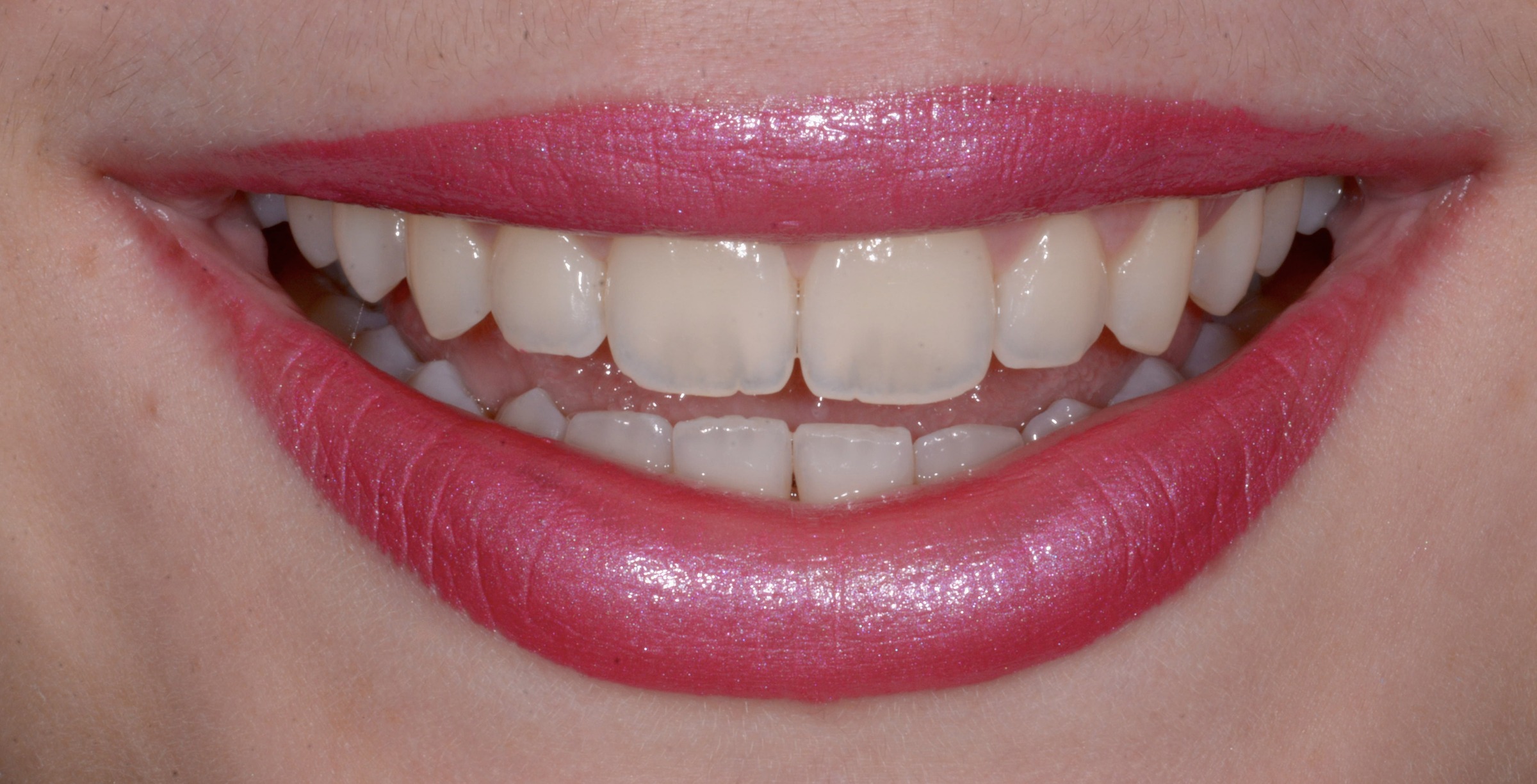 Risultato estetico bio-mimetico: denti naturali, Studio Calesini Roma